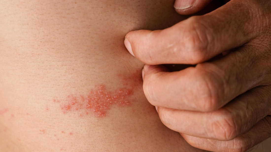 Sight of rash and blisters due to shingles on back, medical condition.