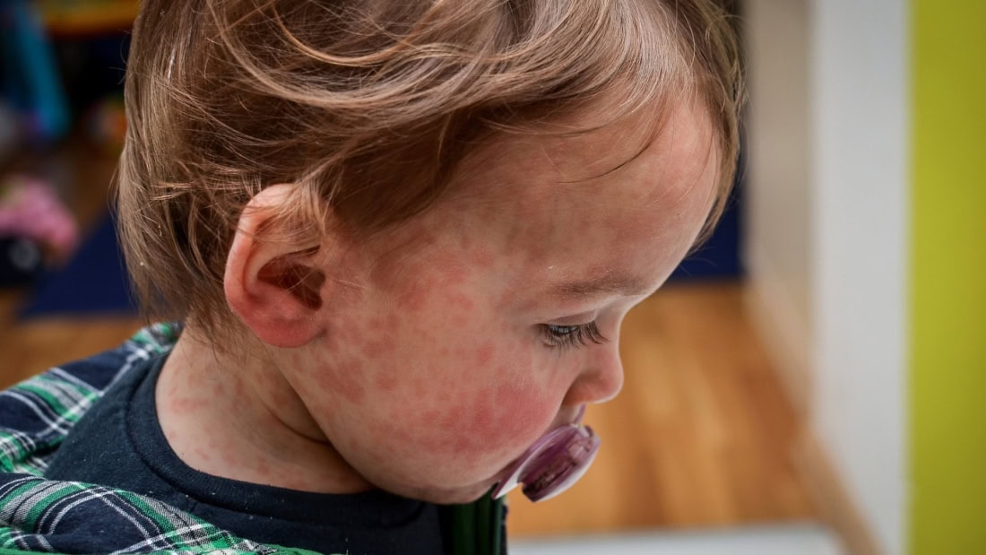 Skin rash and fever in a child with measles, medical symptoms and diagnosis.